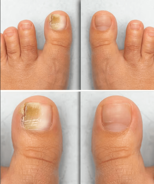 Footer Fungi - Before and After Treatment with ZXCVBNMQWert Cream