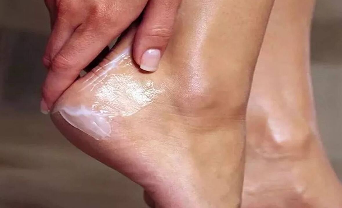 How to handle the fungus of the foot with the zexi cream zxcvbnqwert