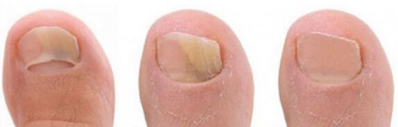 fungus