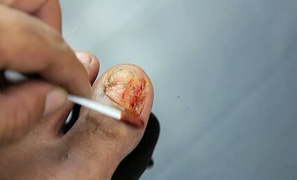 Treatment of lesion with a fungus