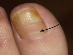 How to know the presence of a nail fungus on the big toe