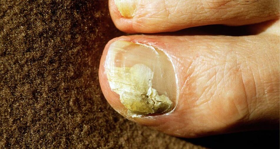 Fungus