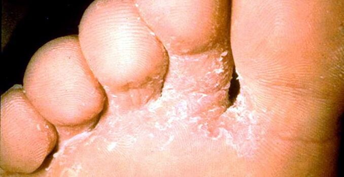 Lesion of skin fungi between fingers