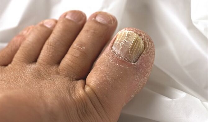 Spread the mycosis lesion on the nail plate