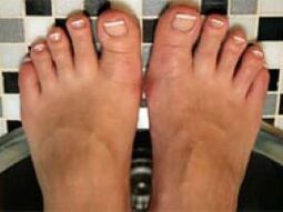 Fungi on nails and skin of the feet