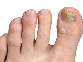 Yellow spots on the nails of fungal legs