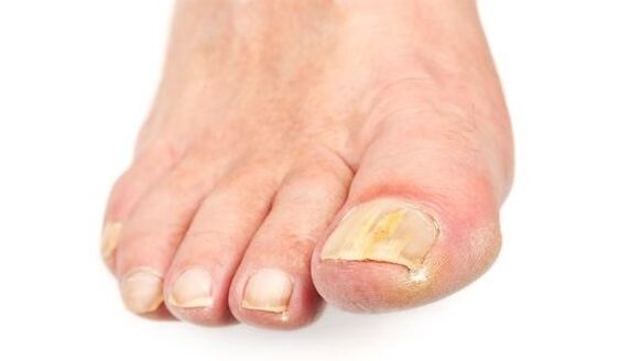 yellowing of the nail due to fungal infection
