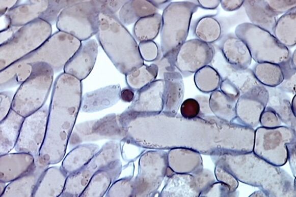 Nail fungus cells under a microscope