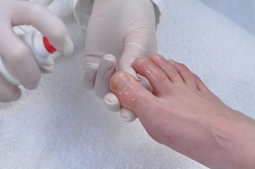 Treatment of toes affected by fungus with an antifungal drug