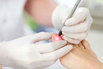 Laser treatment for nail fungus