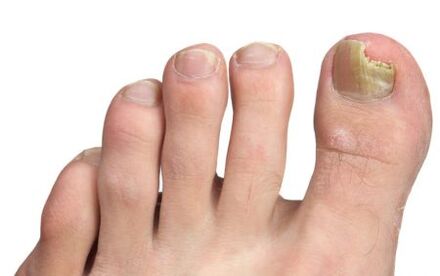 fungus on the nail of the thumb
