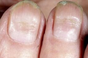 symptoms of nail fungus