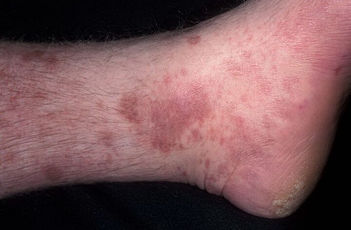 fungal eczema on the feet