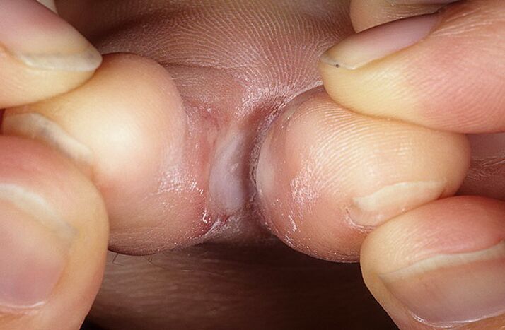 the squamous-hyperkeratotic form of the fungus