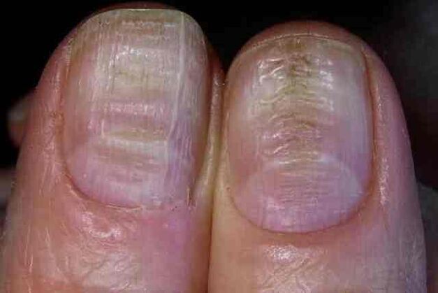fungal infection of the nail plate