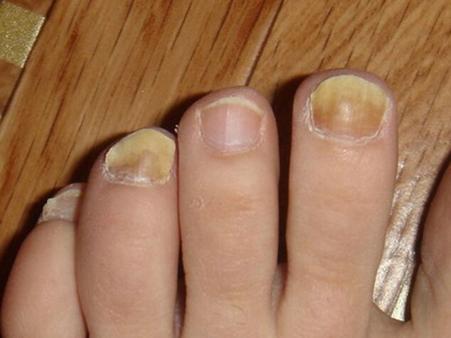 symptoms of toenail fungus