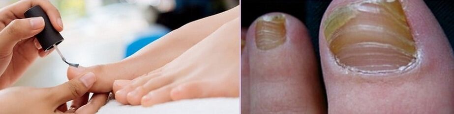 application of varnish for the treatment of fungi