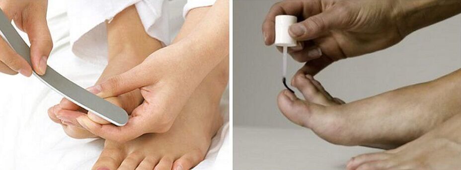 treatment of toenail fungus with varnish